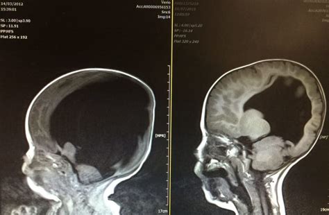 Baby Was Born Without A Brain 3 Years Later Doctors See A Mass Forming