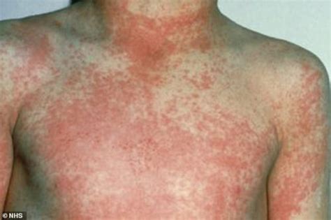 Uk Scarlet Fever Outbreak Is Highest In 50 Years Whoobly