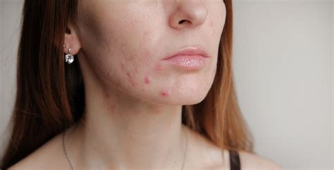Hormonal Acne What It Is And Why It Happens Columbia Skin Clinic Atelier Yuwa Ciao Jp