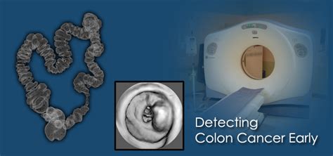 Ct Colonography Northern Virginia Radiology Consultants