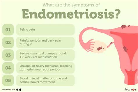 Endometriosis Causes Symptoms Treatments And More