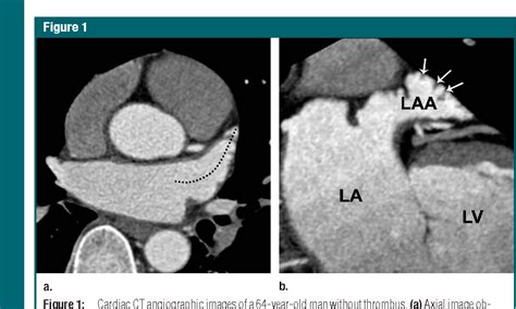 Table 2 From Thrombus In The Left Atrial Appendage In Stroke Patients