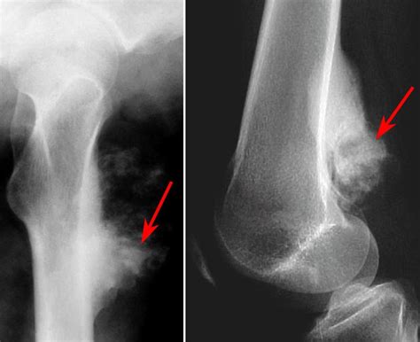Osteosarcoma Of The Knee Human Anatomy