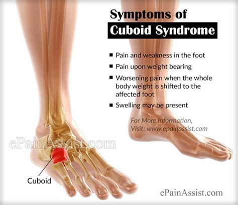 Symptoms Of Cuboid Syndrome Or Cuboid Subluxation Cuboid Syndrome