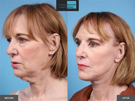 8 Facelift Before And After Photos That Prove Just How Natural Today’s Results Look Tlkm