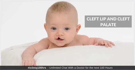 Cleft Lip And Cleft Palate Causes Symptoms Diagnosis Treatments