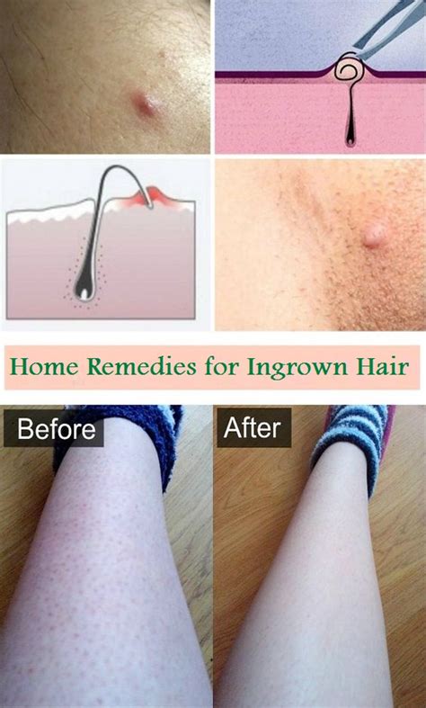 Beauty Enhancers Home Remedies For Ingrown Hair