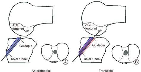 Effects Of Anteromedial Portal Versus Transtibial Acl Tunnel Preparation On Contact