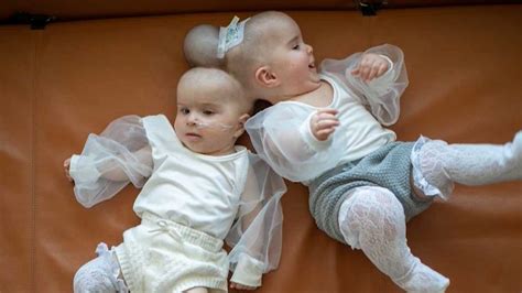 They Both Are Really Happy Babies Rare Conjoined Twins Successfully