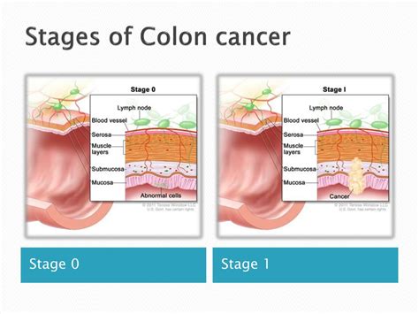 Colorectal Cancer Stages