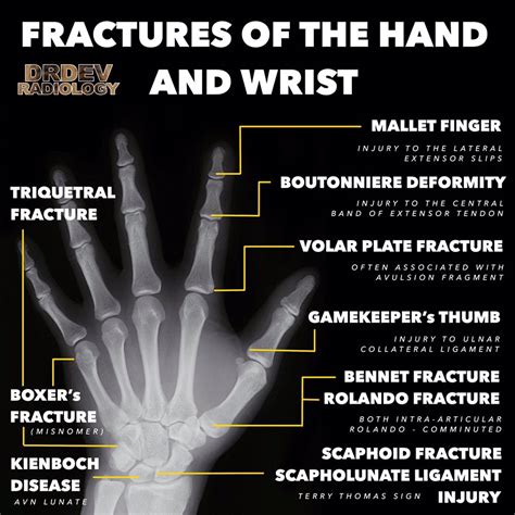 Types Of Fractures X Ray