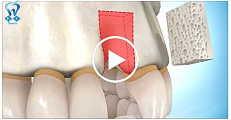 Rf Odonto Bloco De Enxerto ósseo Para Implante Vídeo Demostrativo