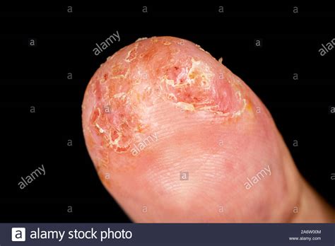 Atopic Eczema High Resolution Stock Photography And Images Alamy