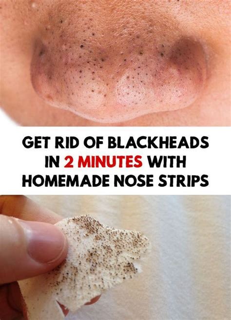 How To Remove Blackheads Without Nose Strips Howotremvo