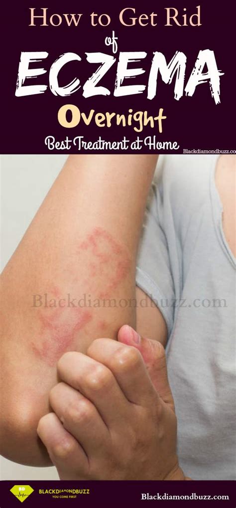 How To Cure Eczema Permanently 10 Home Remedies For Eczema