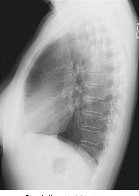 Figure 1 From Lateral Chest Radiograph A Systematic Approach
