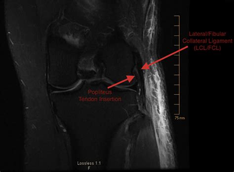 Isolated Complete Rupture Of The Biceps Femoris Insertion A Surgical