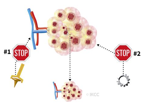 Targeted Therapies For Kidney Cancer Ikcc International Kidney