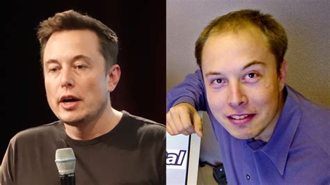 Story Of Elon Musk S Hair Transplant Elon Musk Hair Transformation