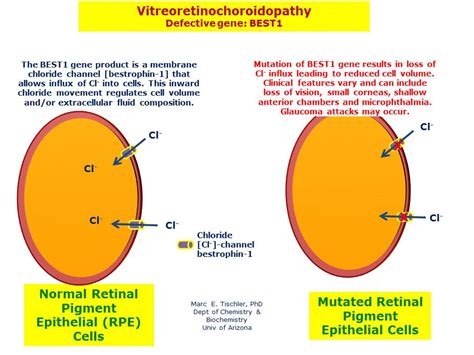 Vitreoretinochoroidopathy Hereditary Ocular Diseases