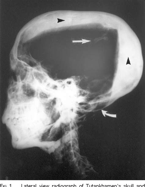 Figure 1 From The Skull And Cervical Spine Radiographs Of Tutankhamen