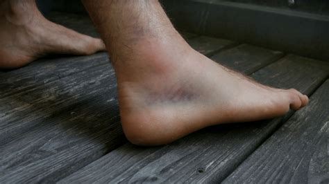 How Should I Manage My Ankle Injury