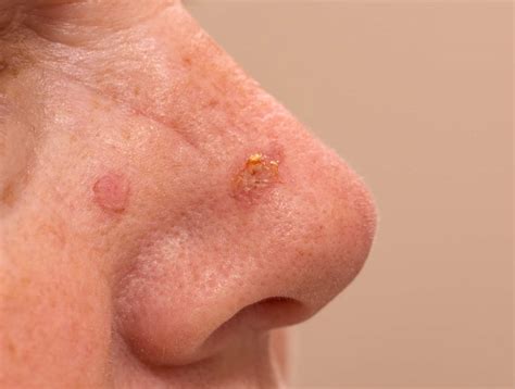Actinic Keratosis Symptoms Causes Treatment And Cost
