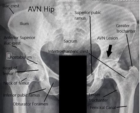 Alcohol Intake Avascular Necrosis Of The Hip Complete Orthopedics