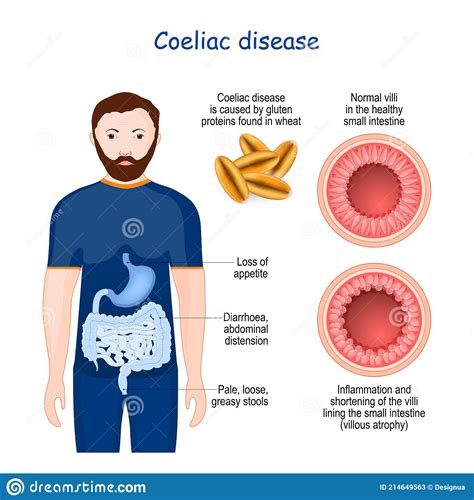 Coeliac Disease Cross Section Of Small Bowel With Normal Villi And