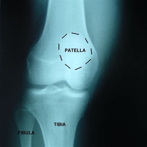 Normal Pediatric Knee X Ray