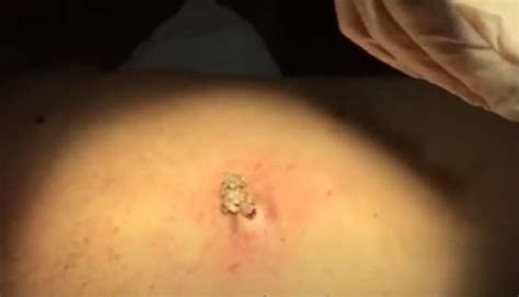 Cyst Explosion 2020 New Pimple Popping Videos