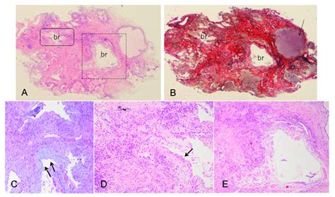 Transbronchial Lung Cryobiopsy In A Case Of MPO ANCA Positive ILD A
