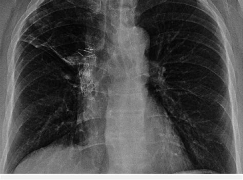 Follow Up Chest X Ray After Surgical Lung Biopsy Showing Resolution Of