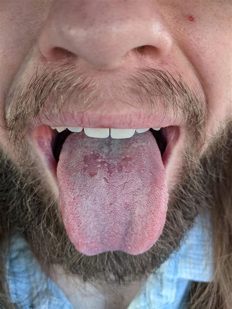 What Is This Bald Red Patch On My Tongue Been Here A Few Months R
