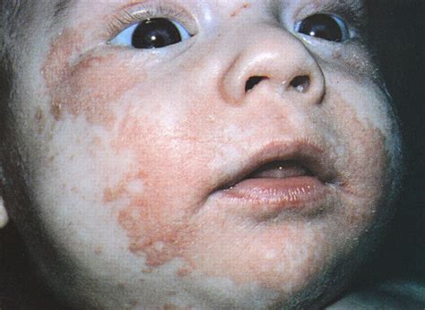 Periorificial Dermatitis And Irritability In An Infant—quiz Case