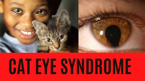 Cat Eye Syndrome Summary Symptoms Signs Causes Treatment Diagnosis