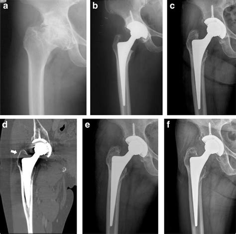 Osteolysis Around The Femoral Stem A Preoperative Anteroposterior