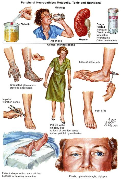 Research suggests that foot neuropathy indicates some kind of a problem or malfunction with the small nerve for tips about how to test if your foot muscles are weak, keep reading. Peripheral Neuropathy. Causes, symptoms, treatment ...