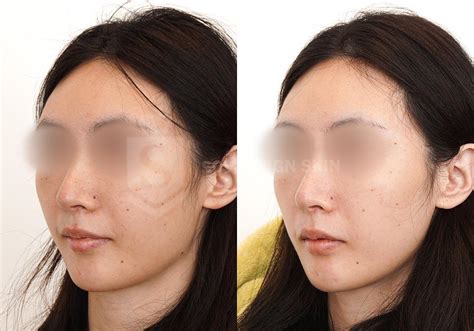 Silkpeel Facial Toronto Silkpeel Microdermabrasion At Sovereign Skin