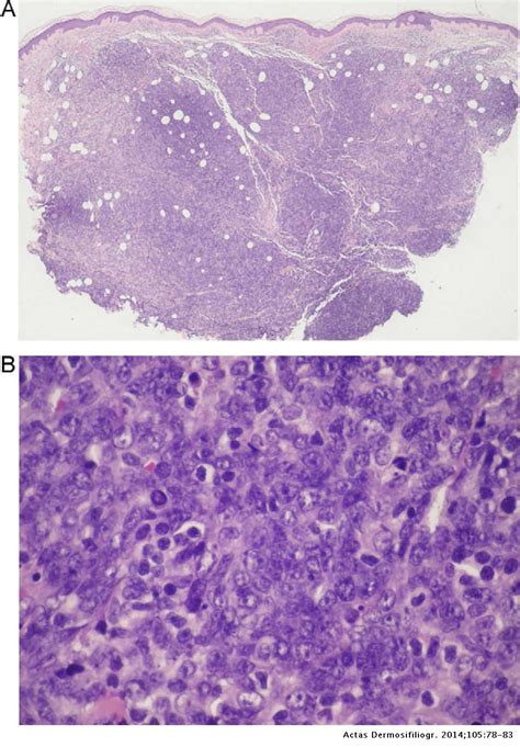 Spontaneous Regression Of Primary Diffuse Large B Cell Lymphoma Leg