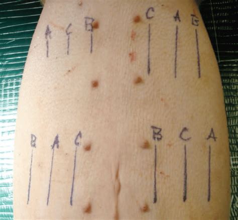 Pre Operative Markings Showing Distribution And Orientation Of Incision