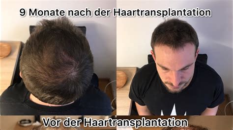Haartransplantation 2021 In Istanbul Meine Reise Zu Vollem Haar Teil