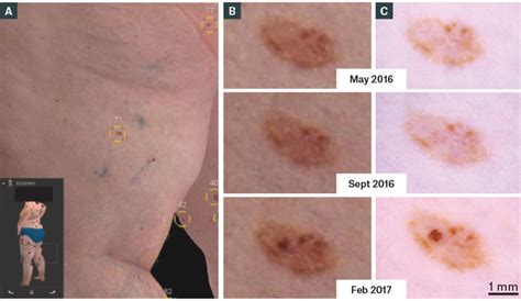 Racgp Diagnosis And Management Of Cutaneous Melanoma