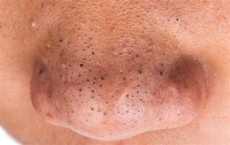 How To Remove Blackheads From Nose Naturally Remove Blackheads At