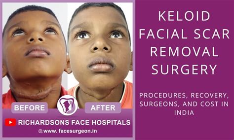 All That You Must Know About Keloid Facial Scar Removal
