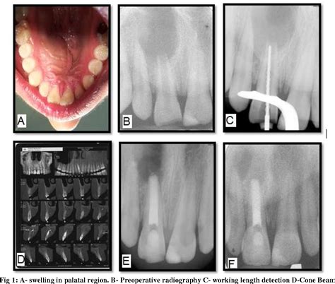 Figure 1 From Endodontic And Surgical Treatment Of An Uppercentral