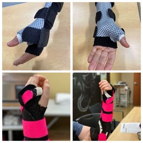 Check Out These Custom Orthoses Made By Our Hand Therapists Tulsa
