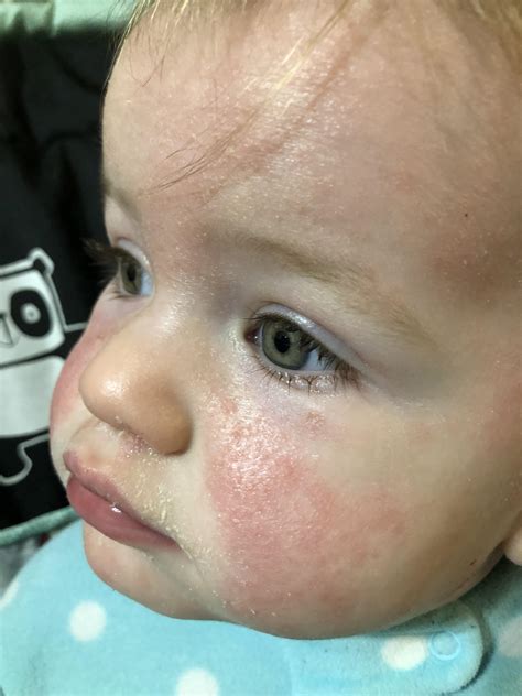 My Daughter18mos Has Had Rashes Like This For About A Year Various