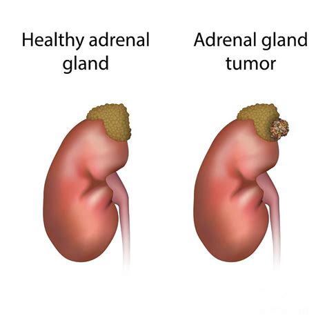 Adrenal Gland Tumour And Healthy Adrenal Gland Photograph By Veronika