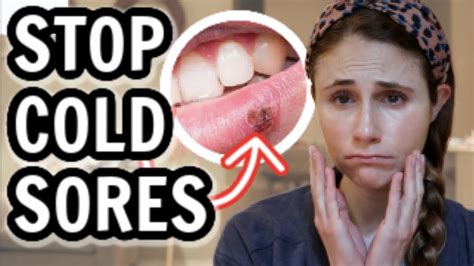 How To Treat Cold Sores Fast Dr Dray Youtube
